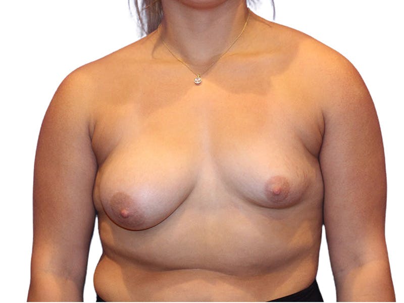 Breast Lift Before & After Gallery - Patient 410675 - Image 1