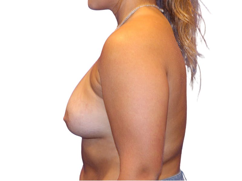 Breast Lift Before & After Gallery - Patient 410675 - Image 4