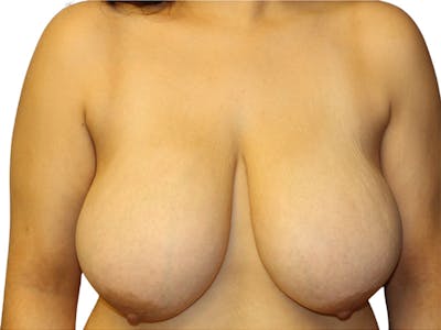 Breast Reduction Before & After Gallery - Patient 399032 - Image 1