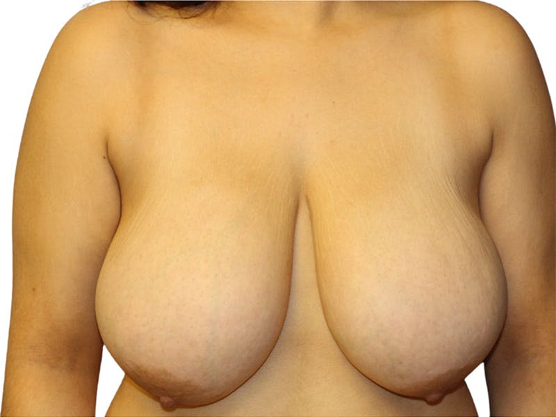 Breast Reduction Before & After Gallery - Patient 399032 - Image 1