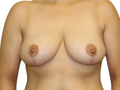 Breast Reduction Before & After Gallery - Patient 399032 - Image 2