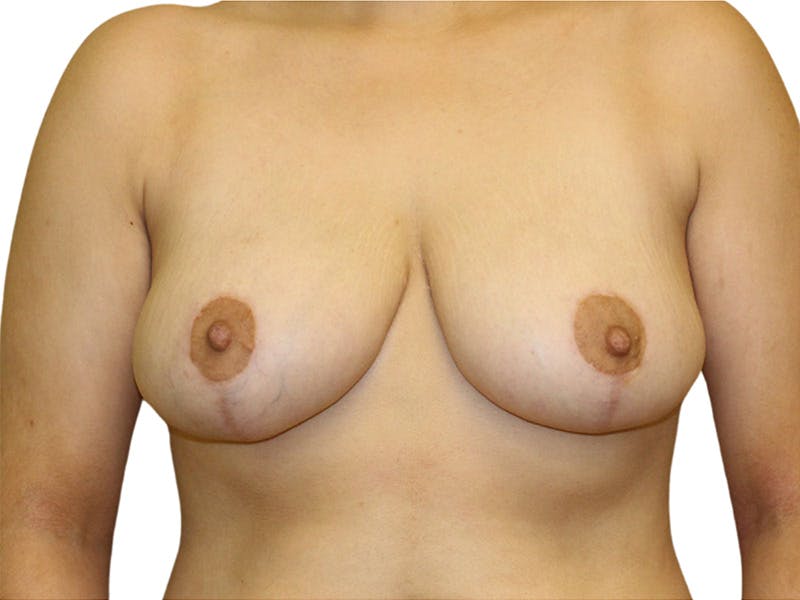 Breast Reduction Before & After Gallery - Patient 399032 - Image 2