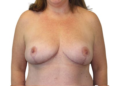 Breast Reduction Before & After Gallery - Patient 261747 - Image 2