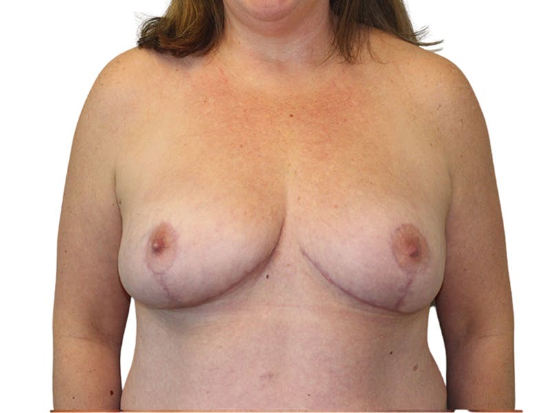 Breast Reduction Before & After Gallery - Patient 261747 - Image 2
