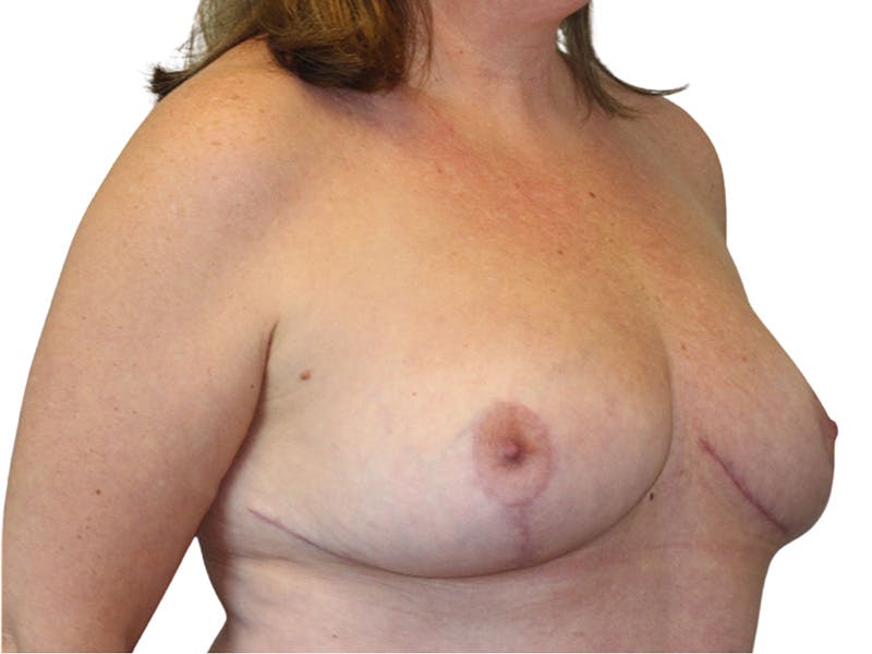 Breast Reduction Before & After Gallery - Patient 261747 - Image 4