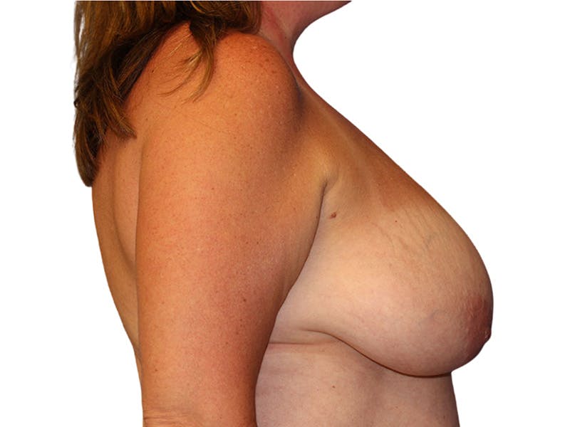 Breast Reduction Before & After Gallery - Patient 261747 - Image 5