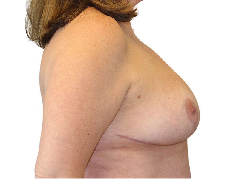 Breast Reduction Before & After Gallery - Patient 261747 - Image 6