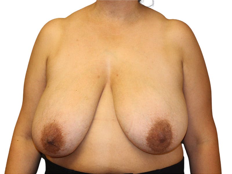 Breast Reduction Before & After Gallery - Patient 650948 - Image 1