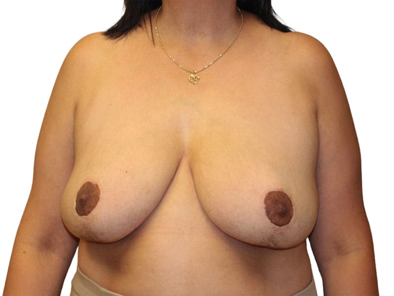 Breast Reduction Before & After Gallery - Patient 650948 - Image 2