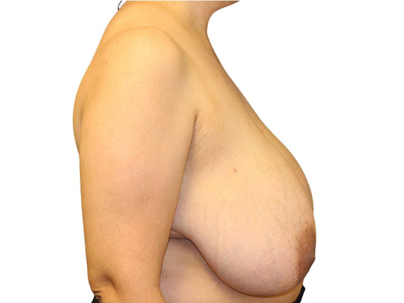 Breast Reduction Before & After Gallery - Patient 650948 - Image 5