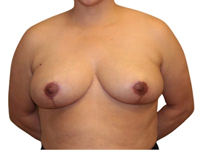 Breast Reduction Before & After Gallery - Patient 422923 - Image 2