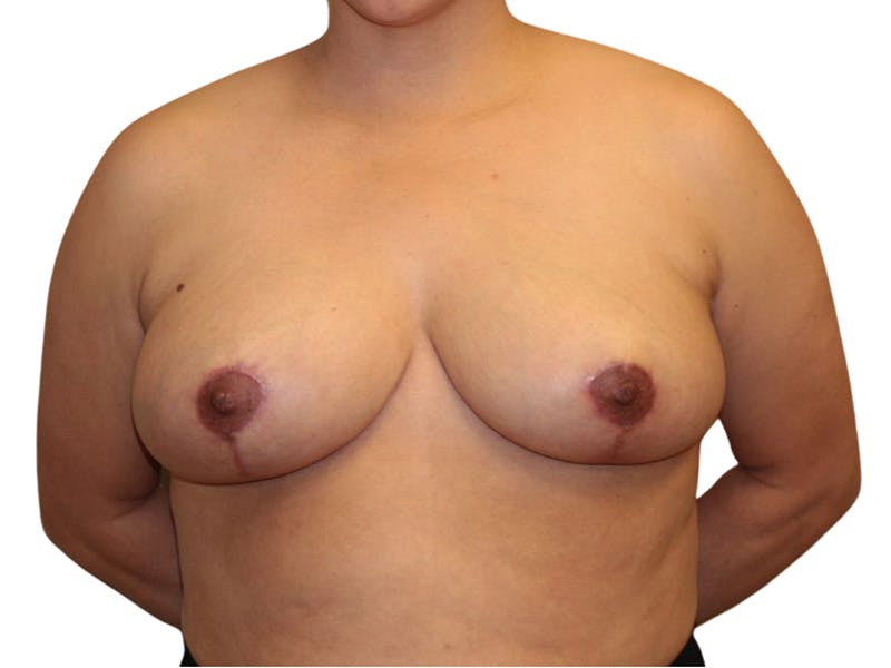 Breast Reduction Before & After Gallery - Patient 422923 - Image 2