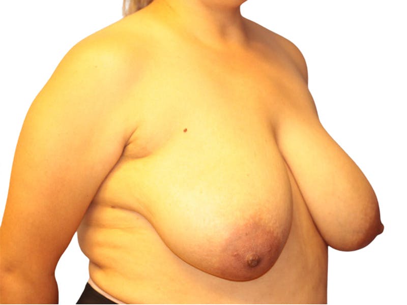 Breast Reduction Before & After Gallery - Patient 422923 - Image 5