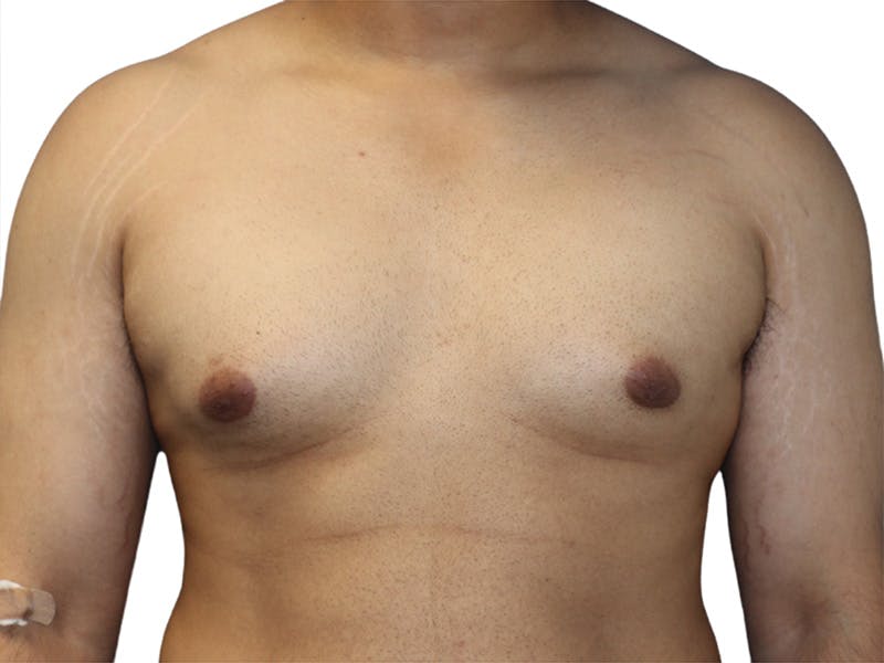 Male Breast Reduction Before & After Gallery - Patient 280340 - Image 1