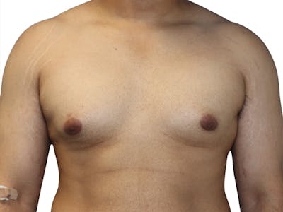 Male Breast Reduction Before & After Gallery - Patient 280340 - Image 1