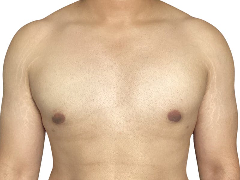 Male Breast Reduction Before & After Gallery - Patient 280340 - Image 2
