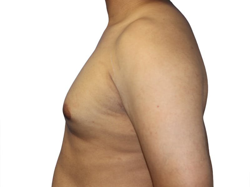 Male Breast Reduction Before & After Gallery - Patient 280340 - Image 3