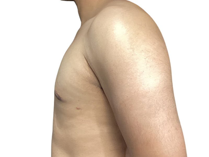Male Breast Reduction Before & After Gallery - Patient 280340 - Image 4