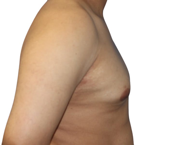 Male Breast Reduction Before & After Gallery - Patient 280340 - Image 5