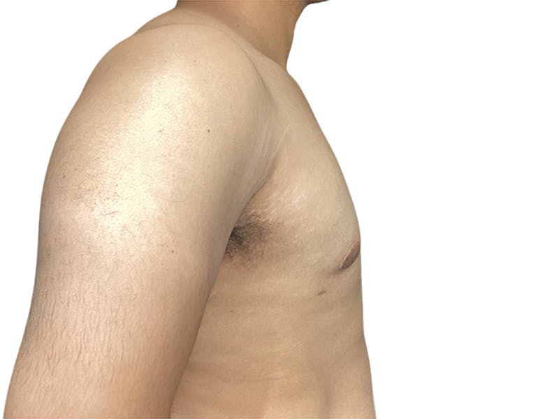 Male Breast Reduction Before & After Gallery - Patient 280340 - Image 6