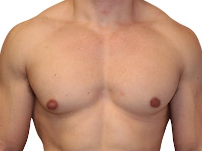Male Breast Reduction Before & After Gallery - Patient 193386 - Image 1