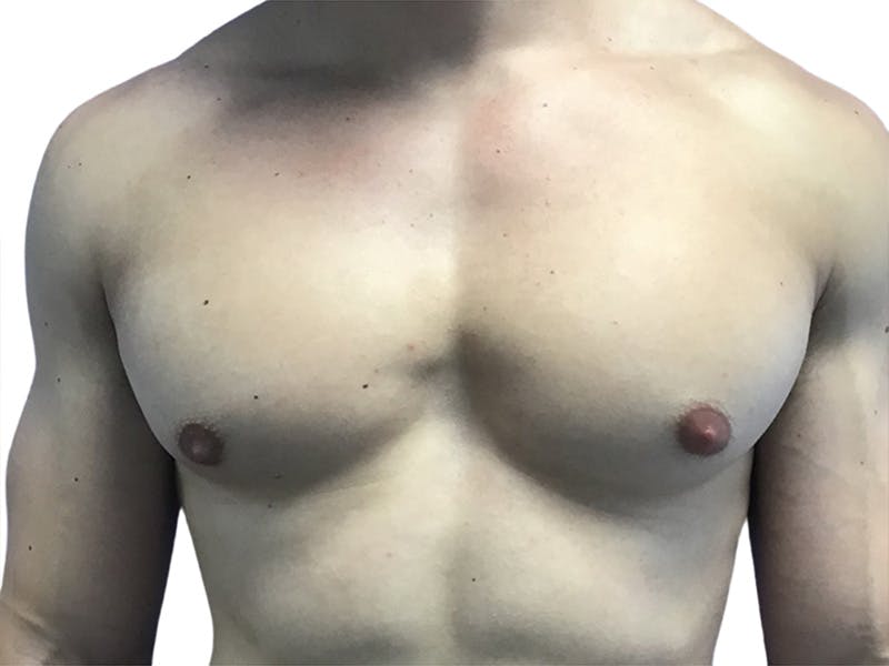 Male Breast Reduction Before & After Gallery - Patient 193386 - Image 2