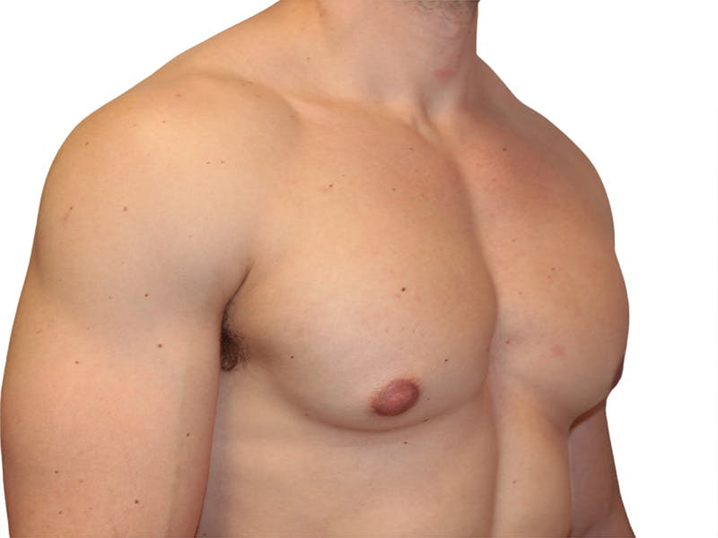 Male Breast Reduction Before & After Gallery - Patient 193386 - Image 3