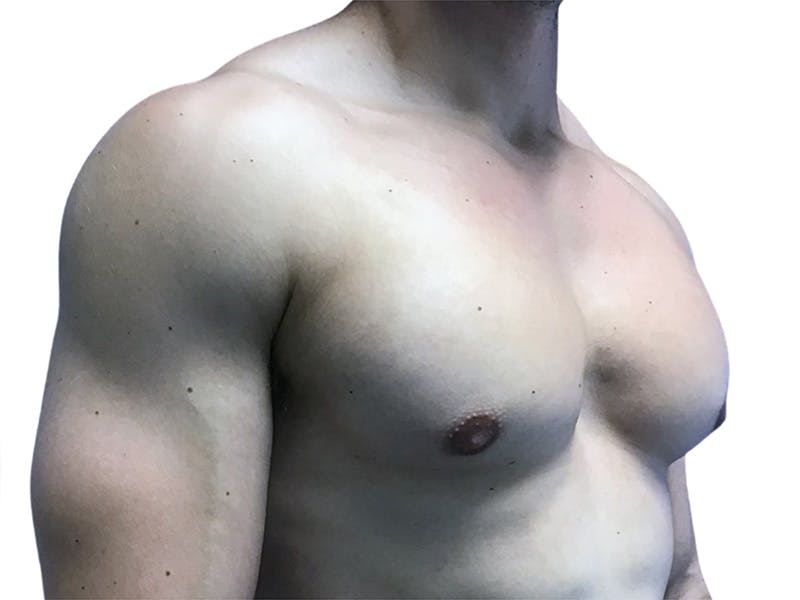 Male Breast Reduction Before & After Gallery - Patient 193386 - Image 4