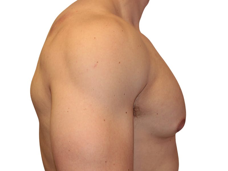 Male Breast Reduction Before & After Gallery - Patient 193386 - Image 5