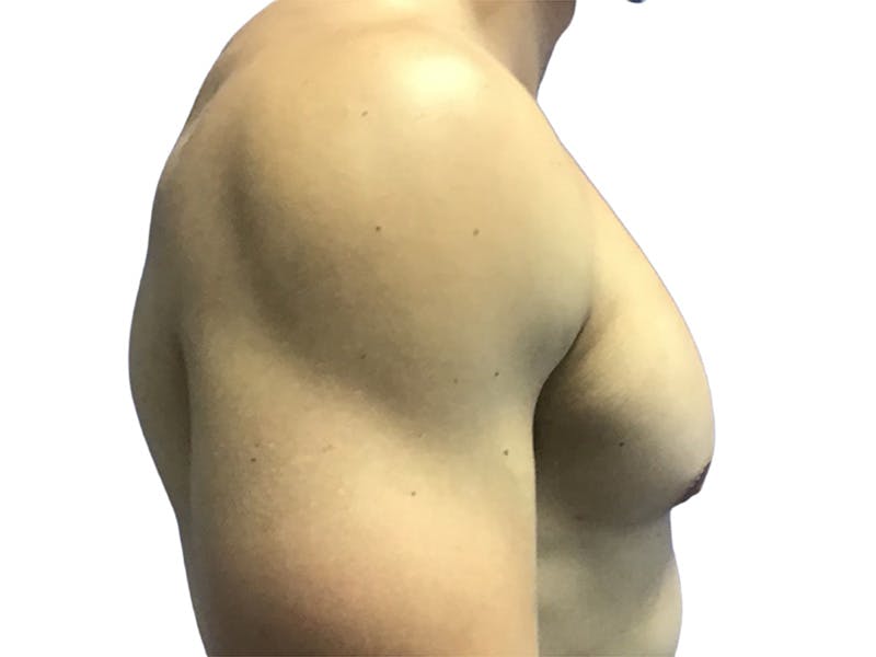 Male Breast Reduction Before & After Gallery - Patient 193386 - Image 6