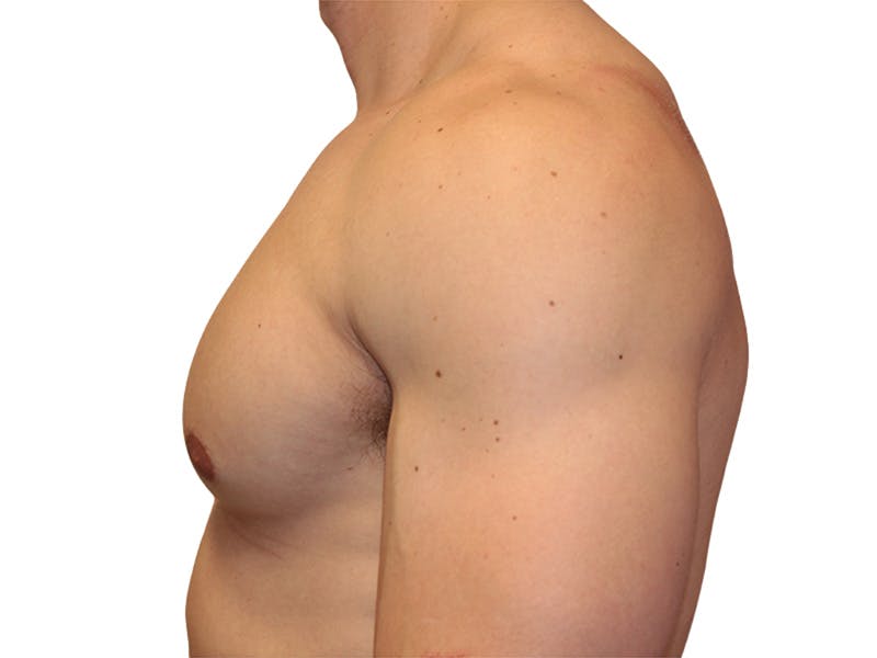Male Breast Reduction Before & After Gallery - Patient 193386 - Image 7