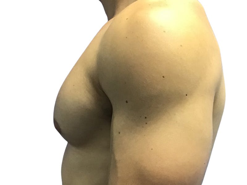 Male Breast Reduction Before & After Gallery - Patient 193386 - Image 8