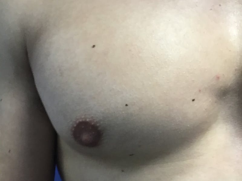 Male Breast Reduction Before & After Gallery - Patient 193386 - Image 10