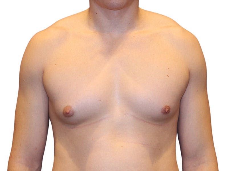 Male Breast Reduction Before & After Gallery - Patient 276801 - Image 1