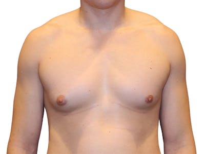 Male Breast Reduction Before & After Gallery - Patient 276801 - Image 1