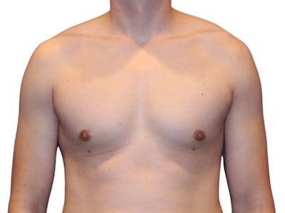 Male Breast Reduction Before & After Gallery - Patient 276801 - Image 2