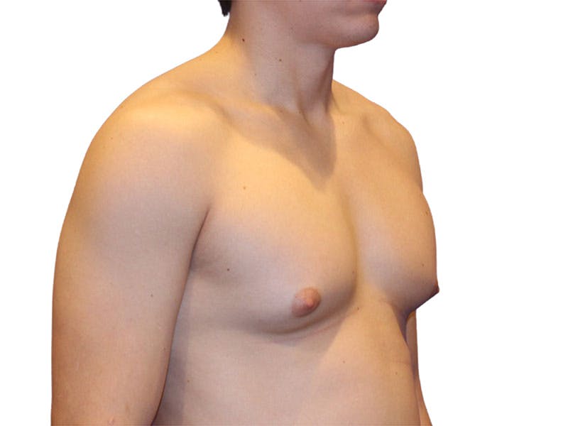 Male Breast Reduction Before & After Gallery - Patient 276801 - Image 3