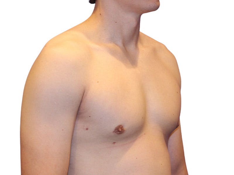 Male Breast Reduction Before & After Gallery - Patient 276801 - Image 4