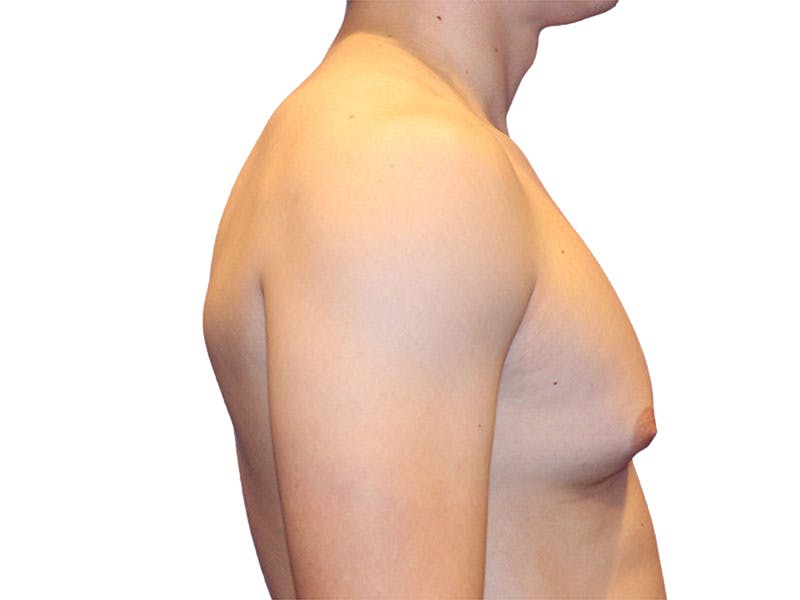 Male Breast Reduction Before & After Gallery - Patient 276801 - Image 5