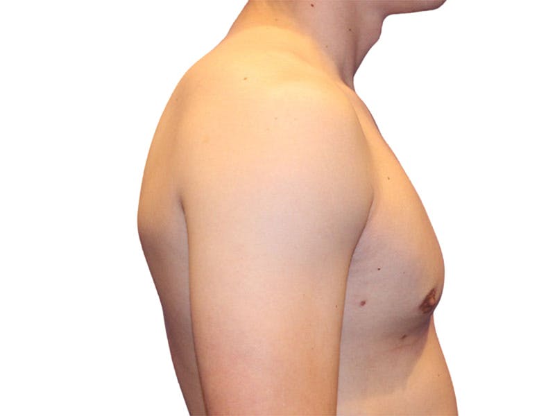 Male Breast Reduction Before & After Gallery - Patient 276801 - Image 6