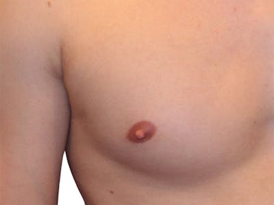 Male Breast Reduction Before & After Gallery - Patient 356933 - Image 1