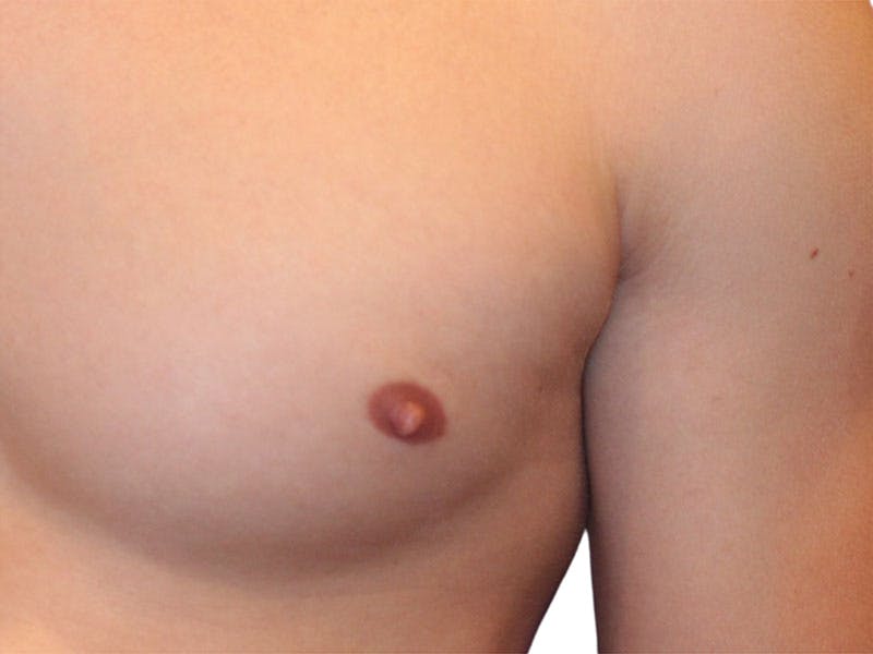 Male Breast Reduction Before & After Gallery - Patient 356933 - Image 3