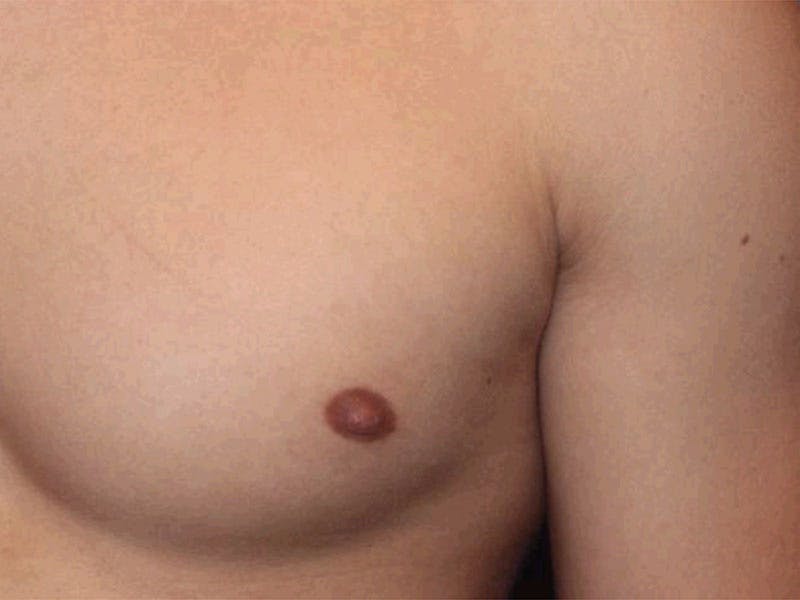 Male Breast Reduction Before & After Gallery - Patient 356933 - Image 4