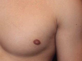 Male Breast Reduction Before & After Gallery - Patient 356933 - Image 4