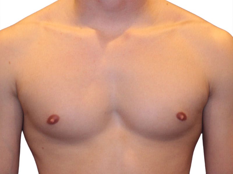 Male Breast Reduction Before & After Gallery - Patient 356933 - Image 5