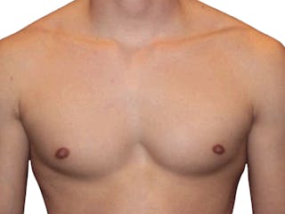 Male Breast Reduction Before & After Gallery - Patient 356933 - Image 6