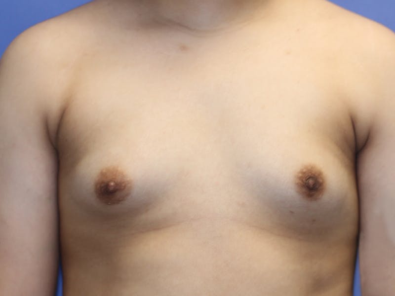 Top Surgery Before & After Gallery - Patient 280081 - Image 1