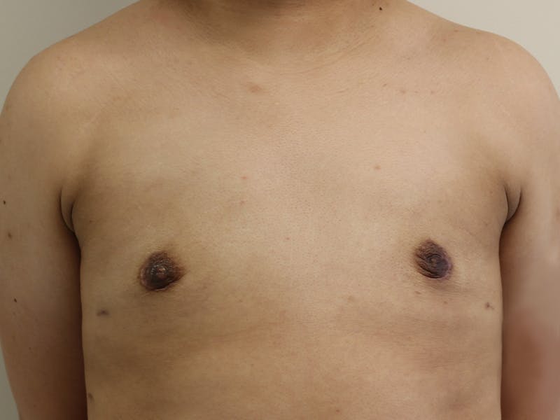 Top Surgery Before & After Gallery - Patient 280081 - Image 2