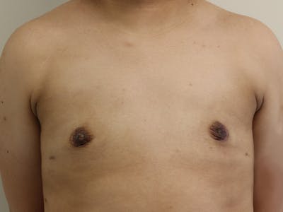 Top Surgery Before & After Gallery - Patient 280081 - Image 2