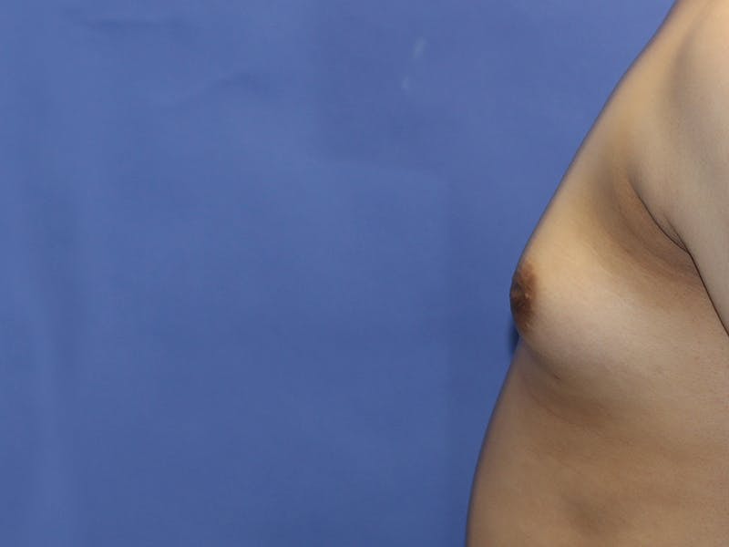 Top Surgery Before & After Gallery - Patient 280081 - Image 3